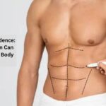 Unlocking Confidence: How Liposuction Can Transform Your Body Image?