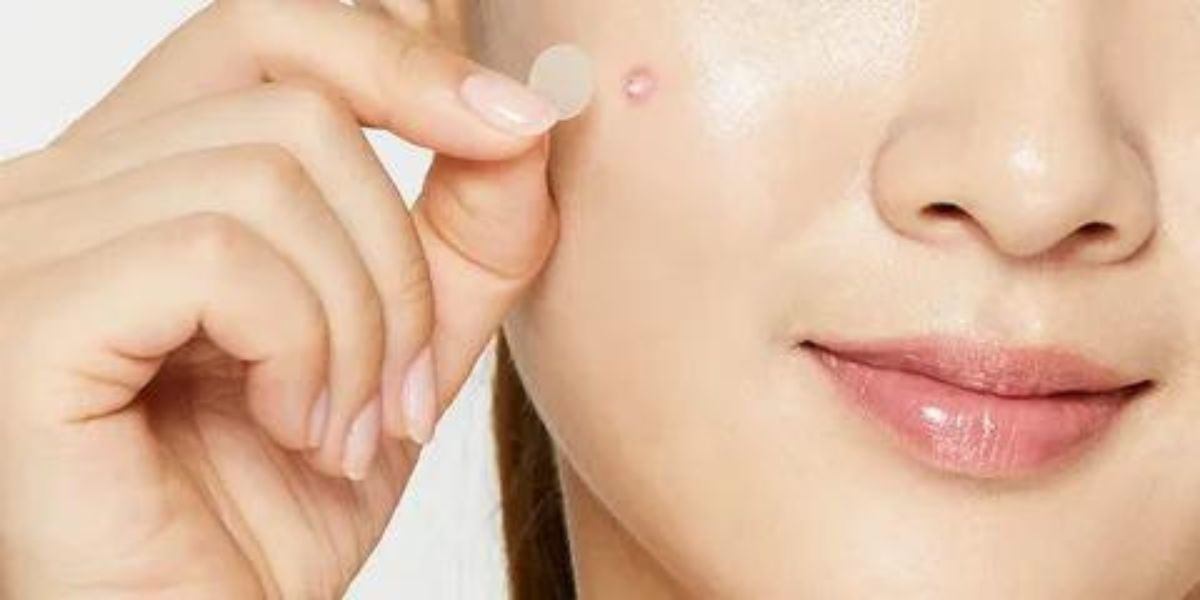 Get Teen Acne Under Control With Effective Pimple Patches