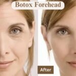 Botox Forehead Before and After: Real Results