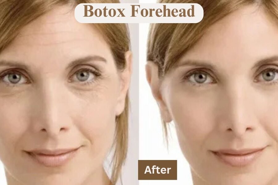 Botox Forehead Before and After: Real Results