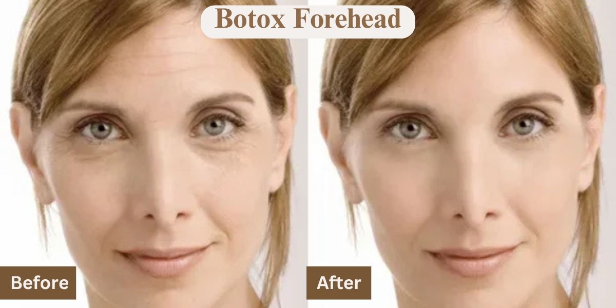 Botox Forehead Before and After: Real Results