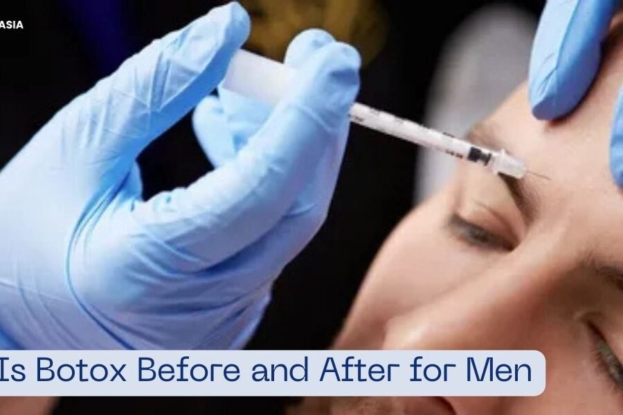 What Is Botox Before and After for Men? | Benefits and Results Explained