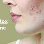 Does Botox help acne?