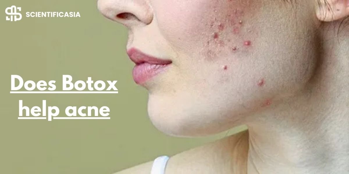 Does Botox help acne?