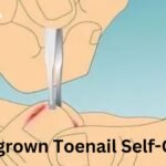 Ingrown Toenail Self-Care: Essential Tips for Preventing Ingrown Toenails