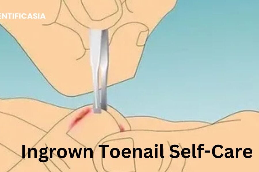 Ingrown Toenail Self-Care: Essential Tips for Preventing Ingrown Toenails