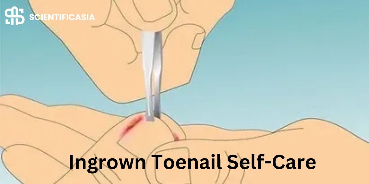 Ingrown Toenail Self-Care: Essential Tips for Preventing Ingrown Toenails