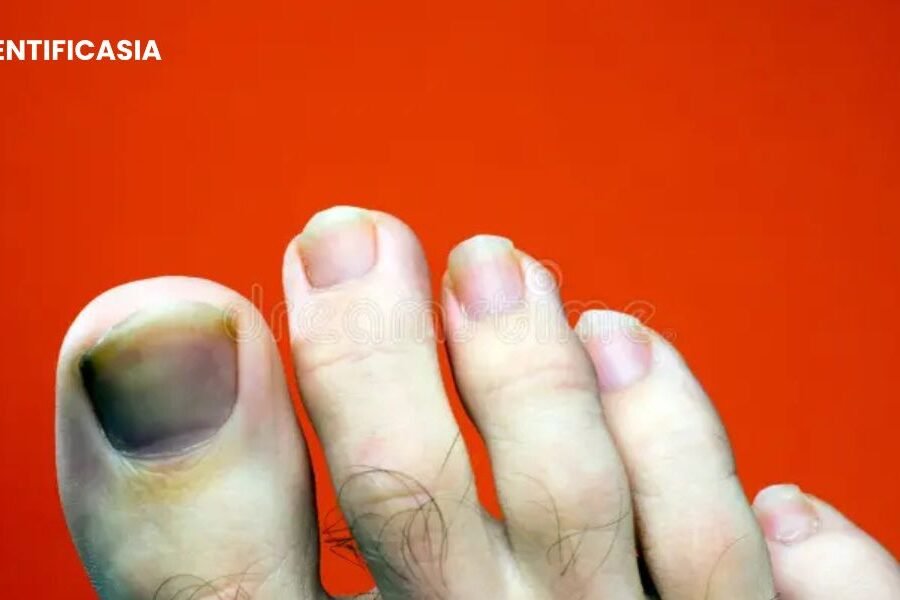 Why Did My Toenail Fall Off Without Pain? Explore The Causes