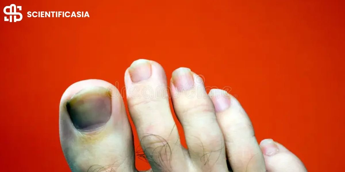 Why Did My Toenail Fall Off Without Pain? Explore The Causes