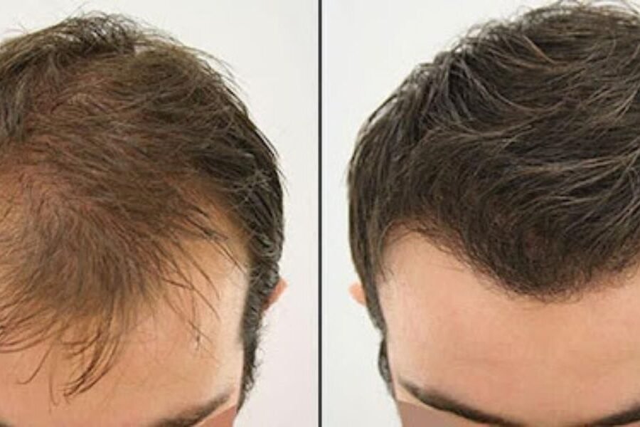 Avoid Cheap Hair Transplant Mistakes
