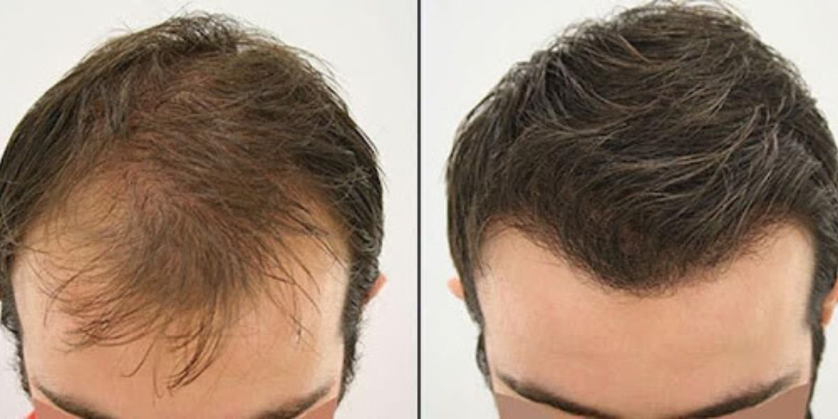 Avoid Cheap Hair Transplant Mistakes