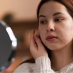 Acne Clearskinstudy: A Comprehensive Guide to Understanding, Treating, and Achieving Clear Skin