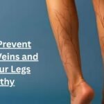 How to Prevent Varicose Veins and Keep Your Legs Healthy